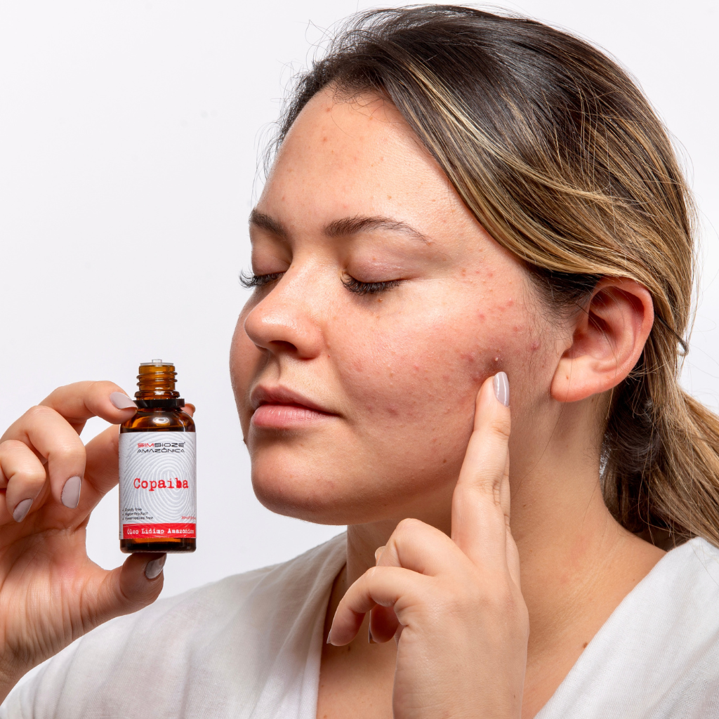 שמן קופאיבה לטיפול בפצעי אקנה, צלקות ובעיות עור